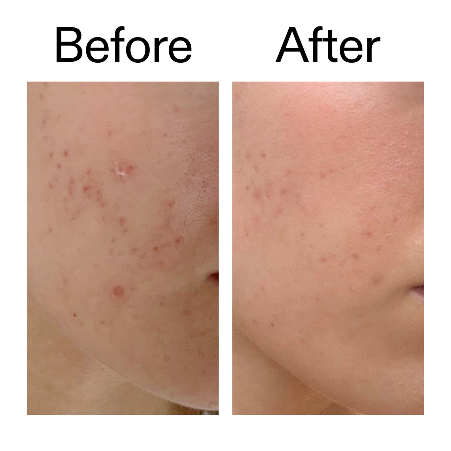 mandelic-acid-treatment-g5 Mandelic_Acid_Treatment_Before_After_2000x2000_4885ac6e-c5d7-4279-a72a-1417af7dce35.jpg