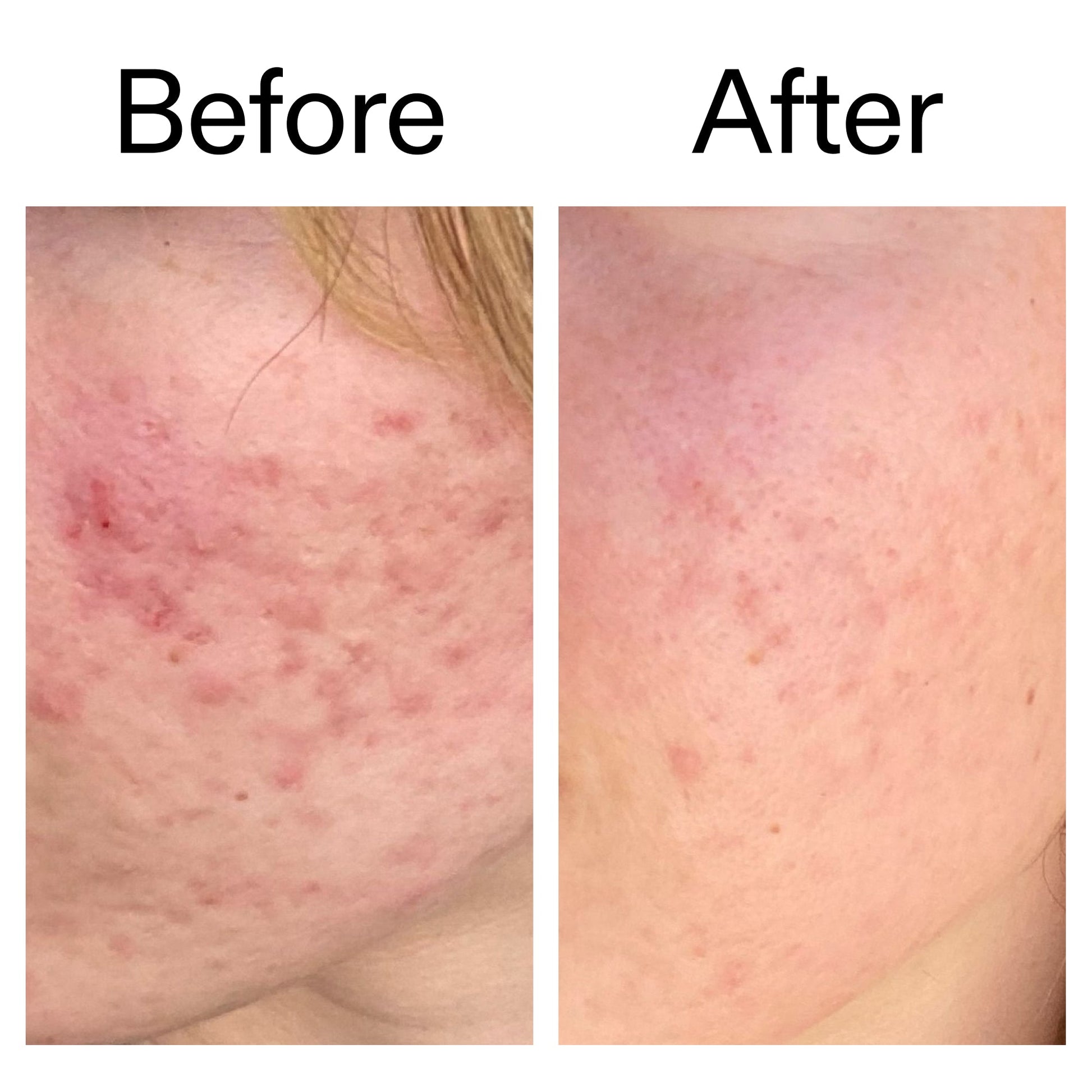 10-azelaic-acid-serum-for-redness-relief-k4 Azealic_Acid_Serum_B_A_Ppage_2000_x_2000.jpg