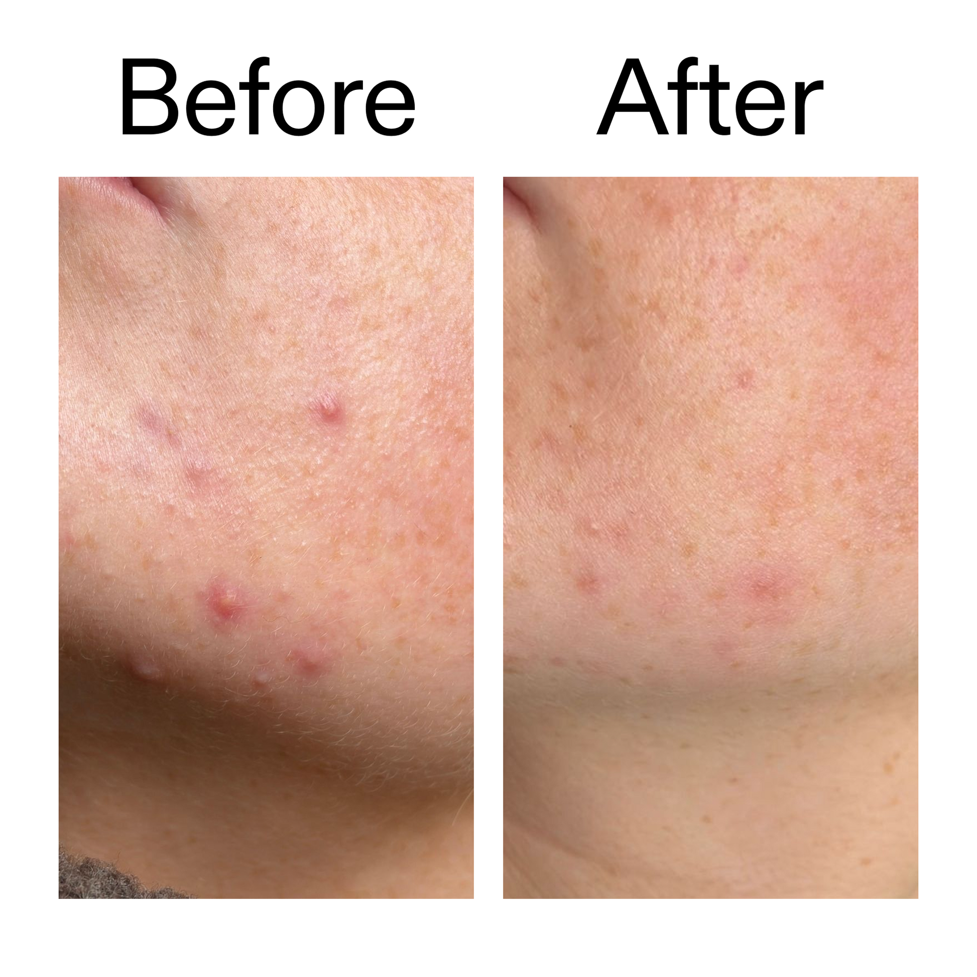 10-azelaic-acid-serum-for-redness-relief-k4 B_A_1_PPAGE.png