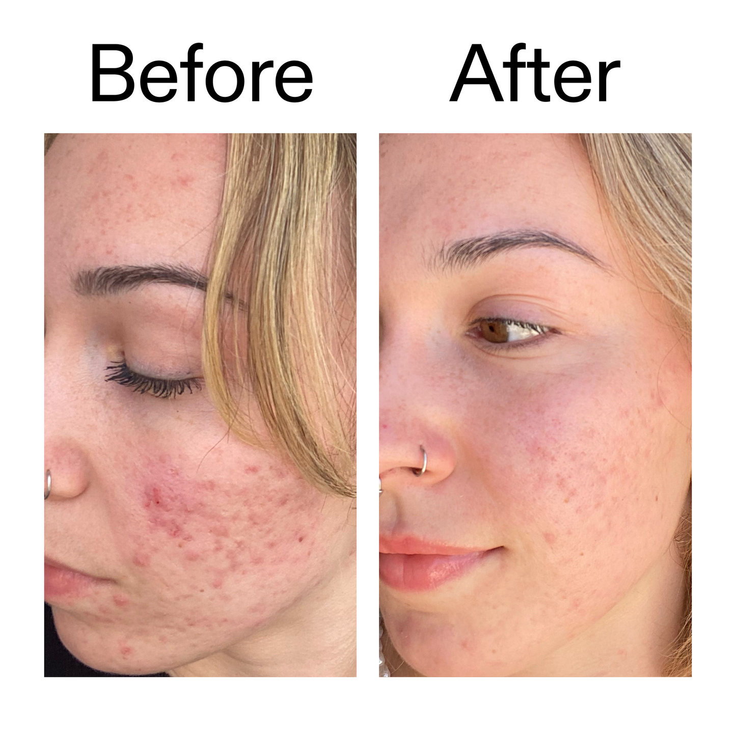 10-azelaic-acid-serum-for-redness-relief-k4 B_A_2_PPAGE.png