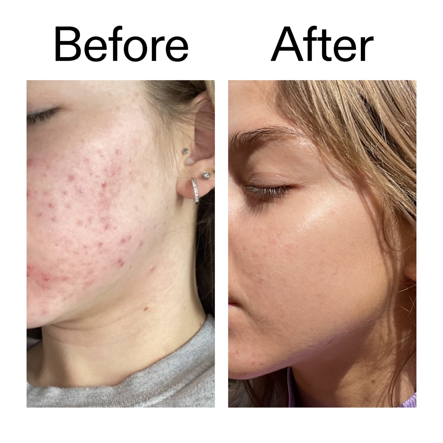 beta-hydroxy-acid-bha-serum-a7 Beta_Hydroxy_Acid_Serum_Before_After_2000x2000_96fda3e5-938d-49ef-bcf2-a0fa6ece4e2c.jpg
