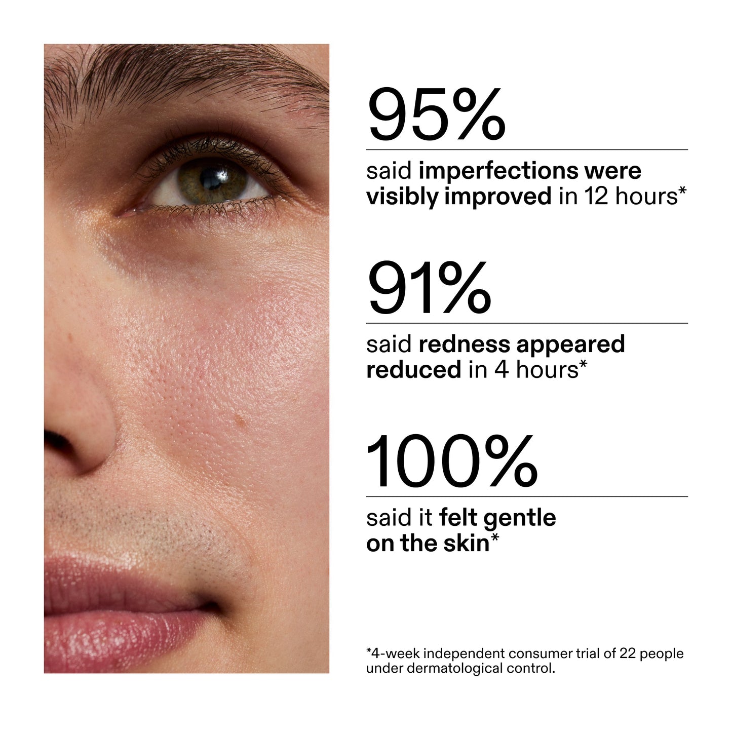 succinic-acid-acne-treatment-r0 CA_Succinic_Acid_Treatment_key_Claims_2000x2000_db91b0f1-7f29-4bfe-bb16-63a47f500960.jpg