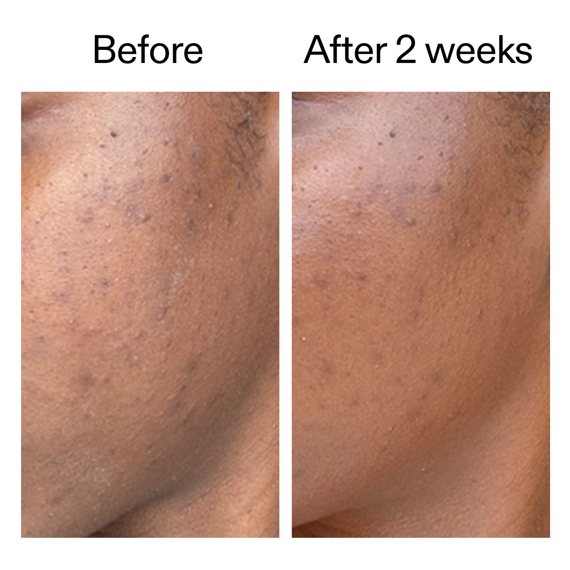 360-acne-clearing-serum-h2 DIOICB_A2000x2000.jpg