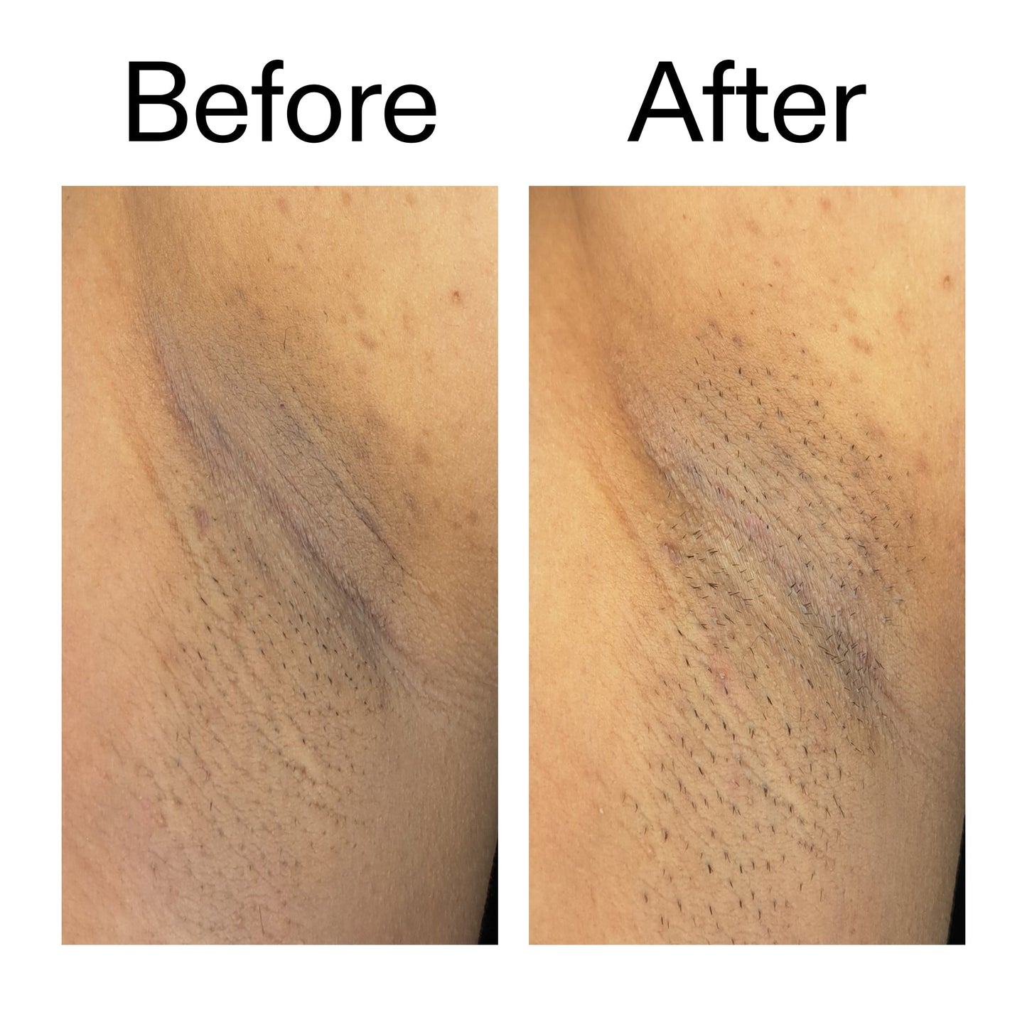 glycolic-acid-exfoliating-body-stick-duo-y2 Glycolic_Acid_Exfoliating_Body_Stick_Before_After_V3_2000x2000_ea919cd9-1439-4a46-82a0-76200eb5bb42.jpg