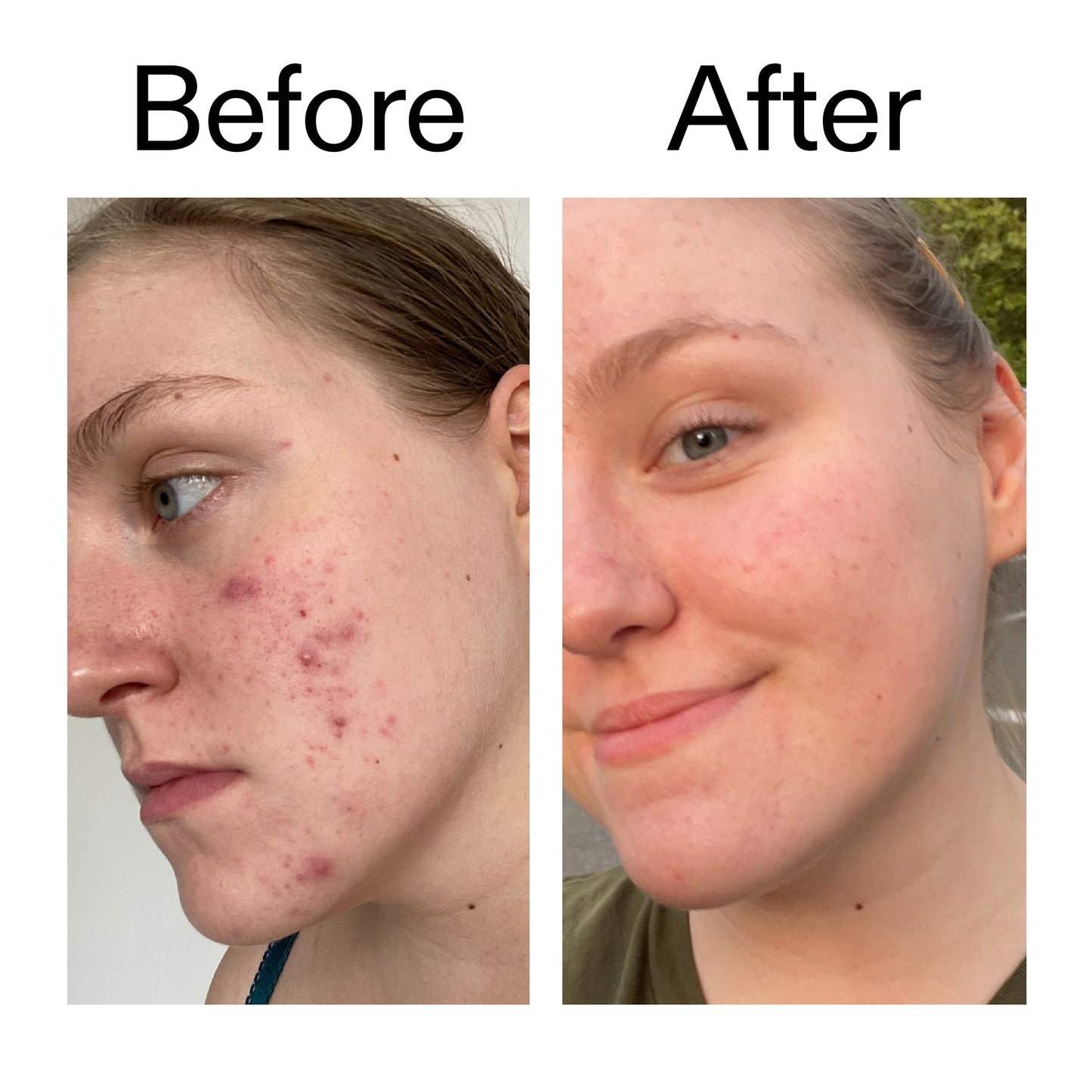 glycolic-acid-toner-y2 Glycolic_Acid_Toner_Before_After_2000x2000_49f0b9f7-e71b-4b2e-a8f8-2ea4b73247bb.jpg