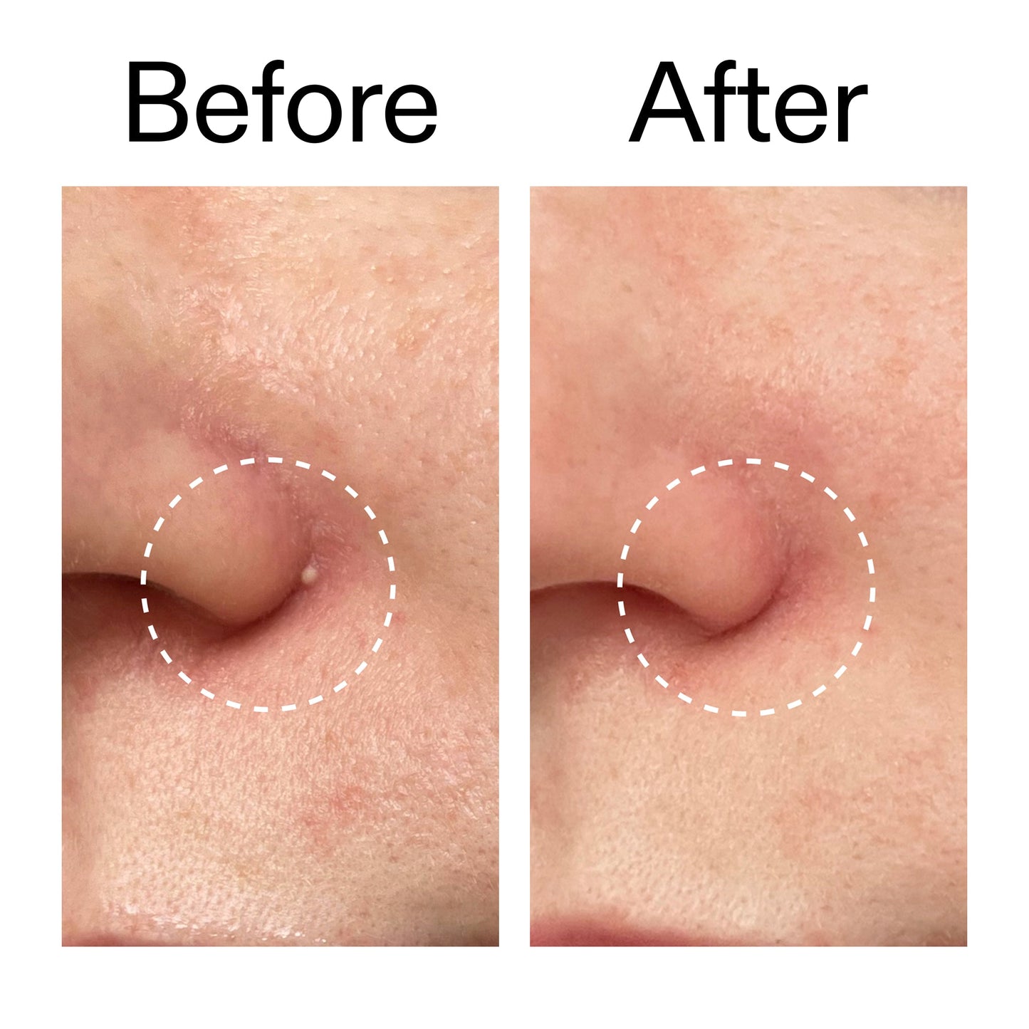 hydrocolloid-invisible-pimple-patches-pack-of-44-a6 Hydrocolloid_Invisible_Pimple_Patches_Before_After_2000x2000_b02aa37b-c78a-4682-91de-9135af5bb7df.jpg