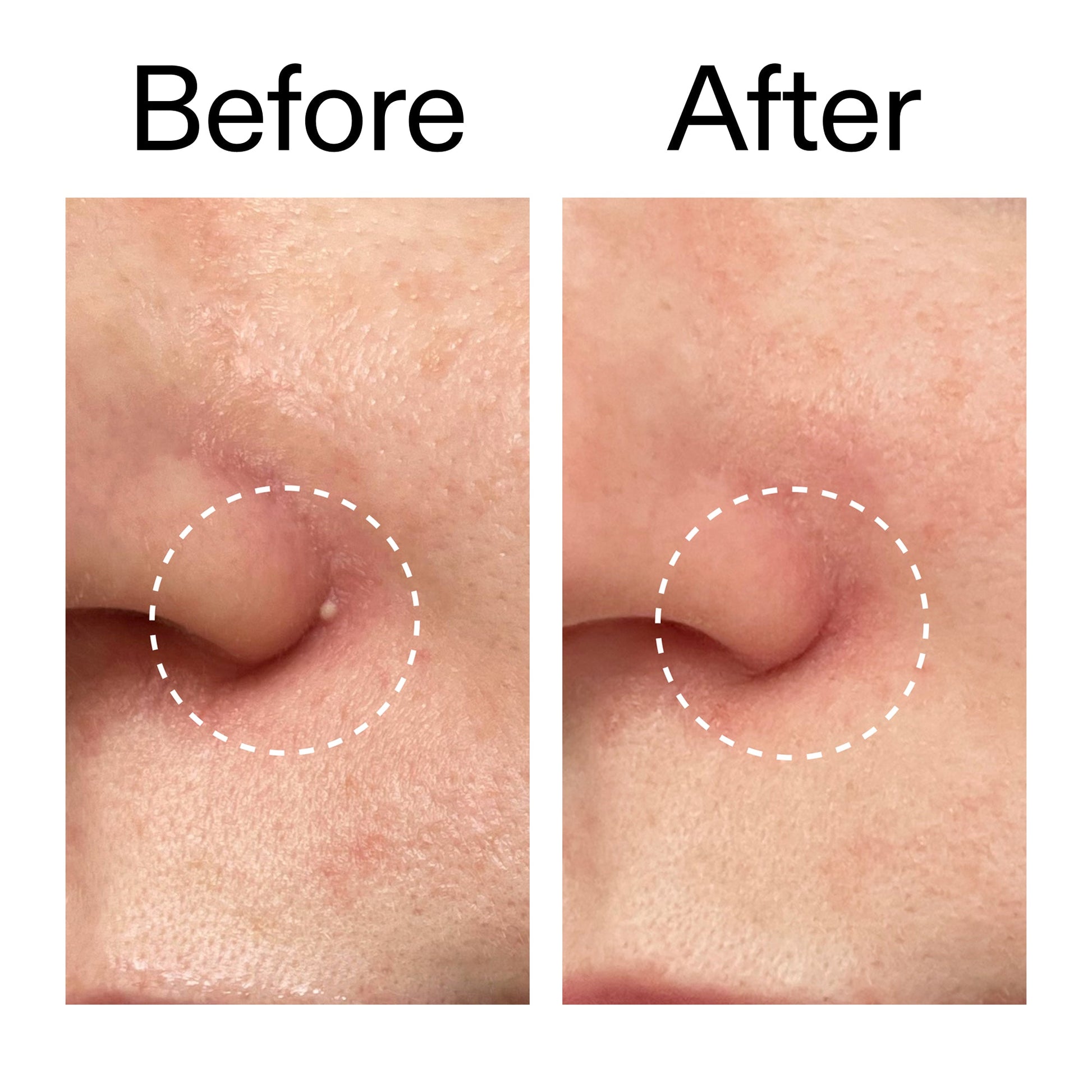 hydrocolloid-invisible-pimple-patches-pack-of-44-a6 Hydrocolloid_Invisible_Pimple_Patches_Before_After_2000x2000_b02aa37b-c78a-4682-91de-9135af5bb7df.jpg