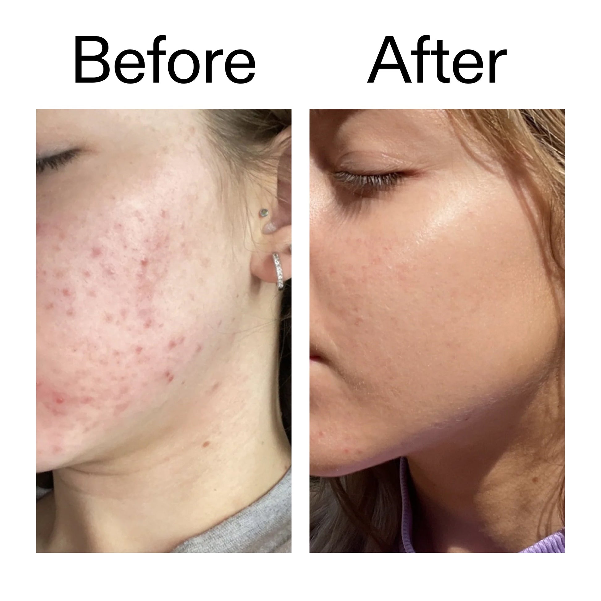 10-niacinamide-serum-s6 Niacinamide_Serum_Before_After_2000x2000_bde32455-9e7d-448e-b053-bef41504f0a9.jpg