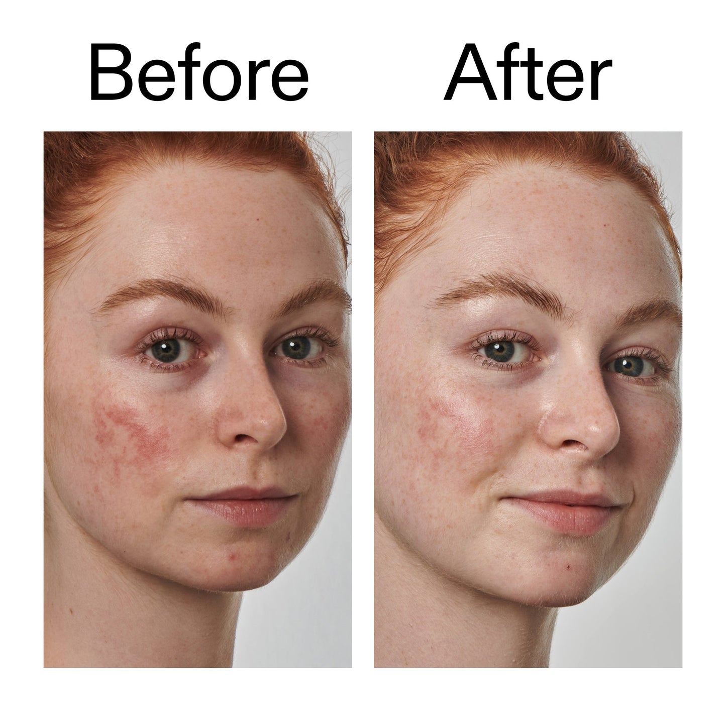 10-azelaic-acid-serum-for-redness-relief-k4 Redness_Relief_Serum_Before_After_2000x2000_3334dc9a-cce9-4e00-8aec-7ad89ca051f2.jpg