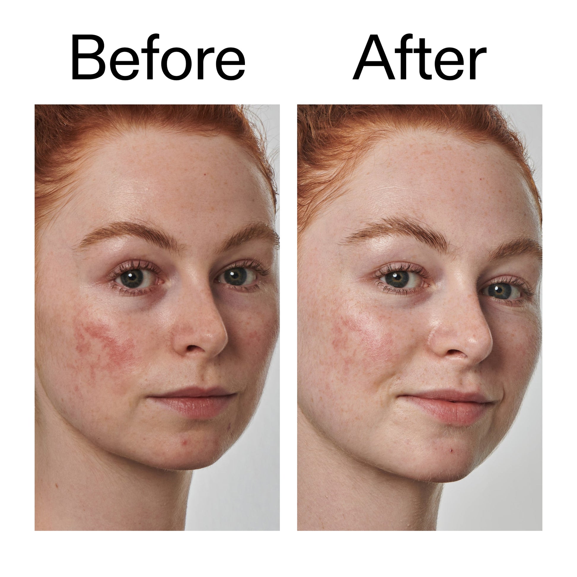 10-azelaic-acid-serum-for-redness-relief-k4 Redness_Relief_Serum_Before_After_2000x2000_3334dc9a-cce9-4e00-8aec-7ad89ca051f2.jpg