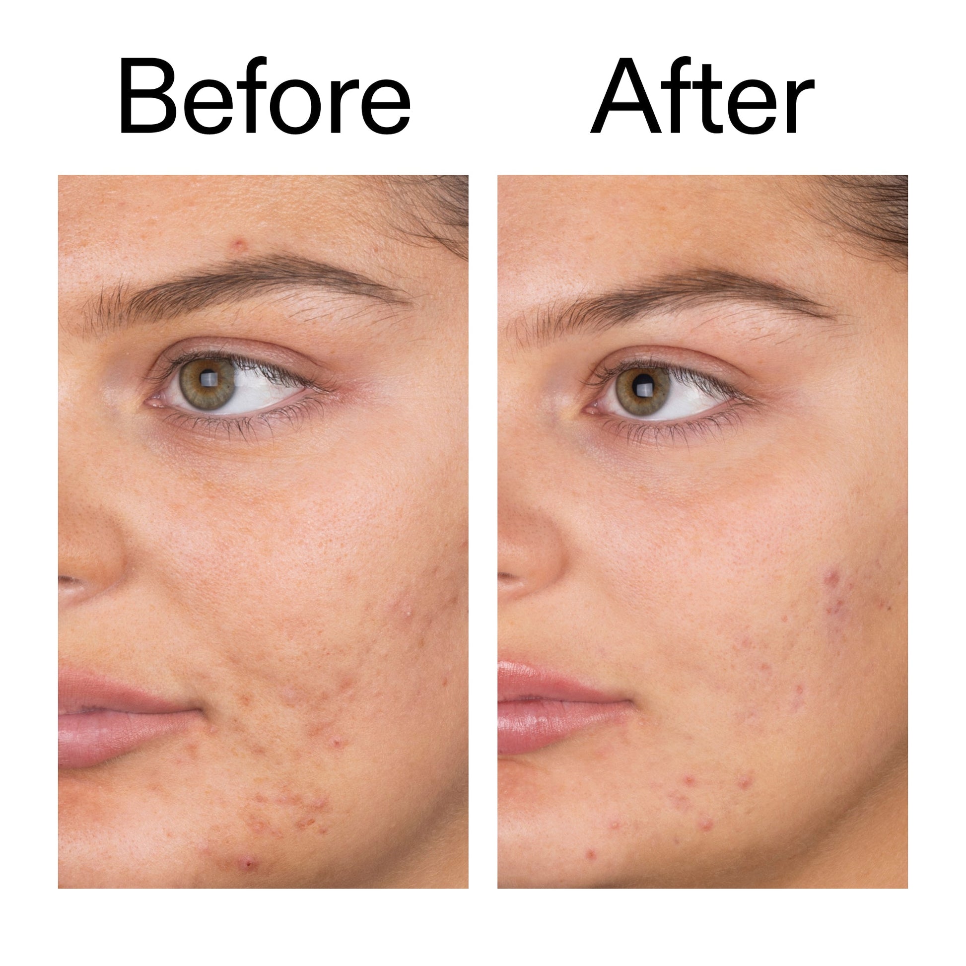 salicylic-acid-cleanser-duo-y9 Salicylic_Acid_Cleanser_-_150ml_Before_After_2000x2000_e7230494-853f-4b07-82b1-27669104c995.jpg