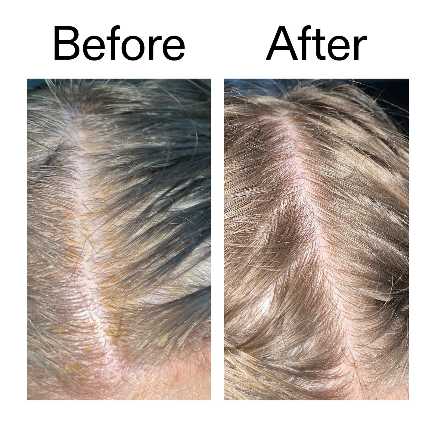 salicylic-acid-exfoliating-scalp-treatment-b5 Salicylic_Acid_Exfoliating_Scalp_Treatment_Before_After_2000x2000_e572a30f-057c-4a48-823b-1c09dc97f8d0.jpg