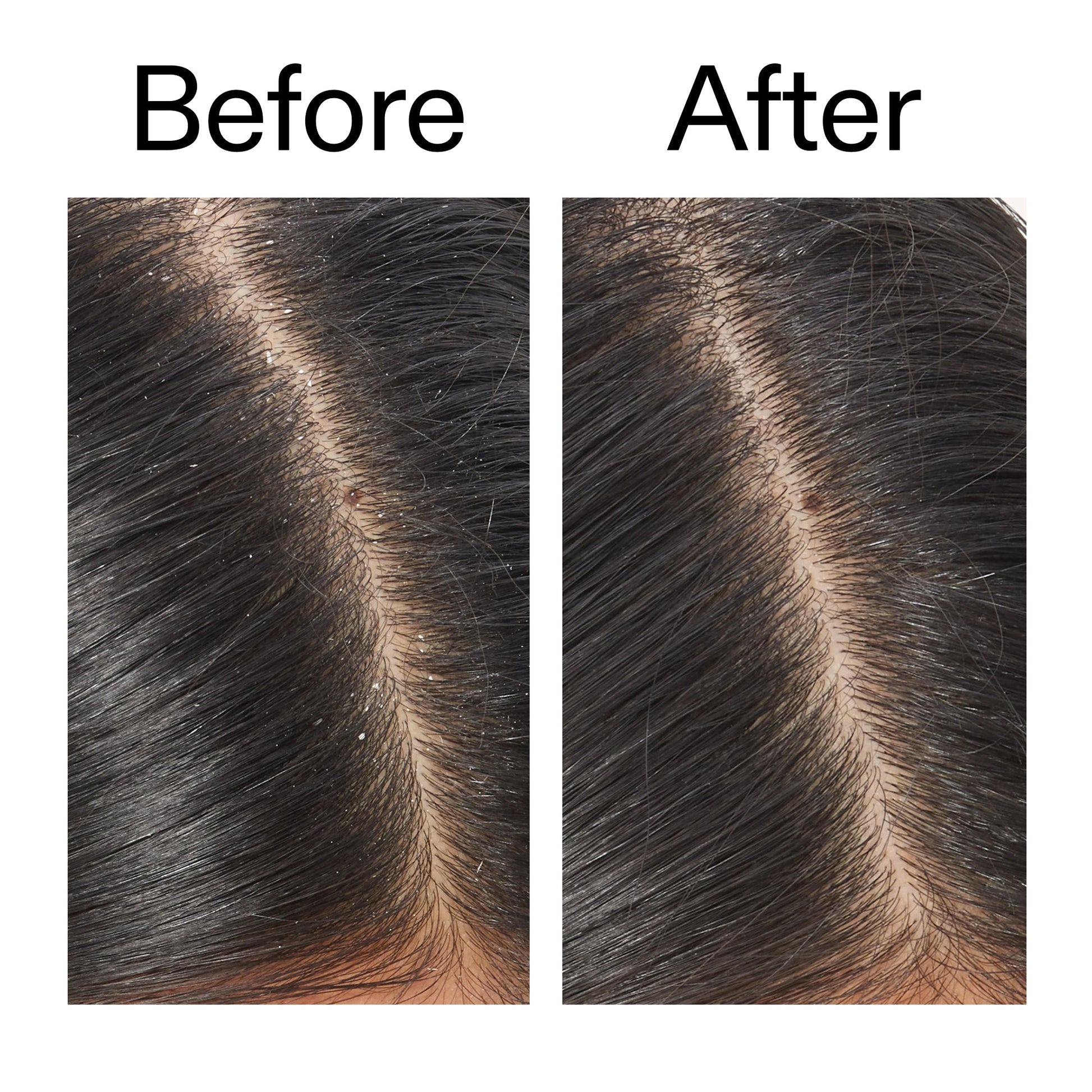 salicylic-acid-exfoliating-scalp-treatment-b5 Salicylic_Acid_Exfoliating_Scalp_Treatment_Before_After_V2_2000x2000_02bd61ad-42bf-490b-b3e3-7e04b2e8a673.jpg