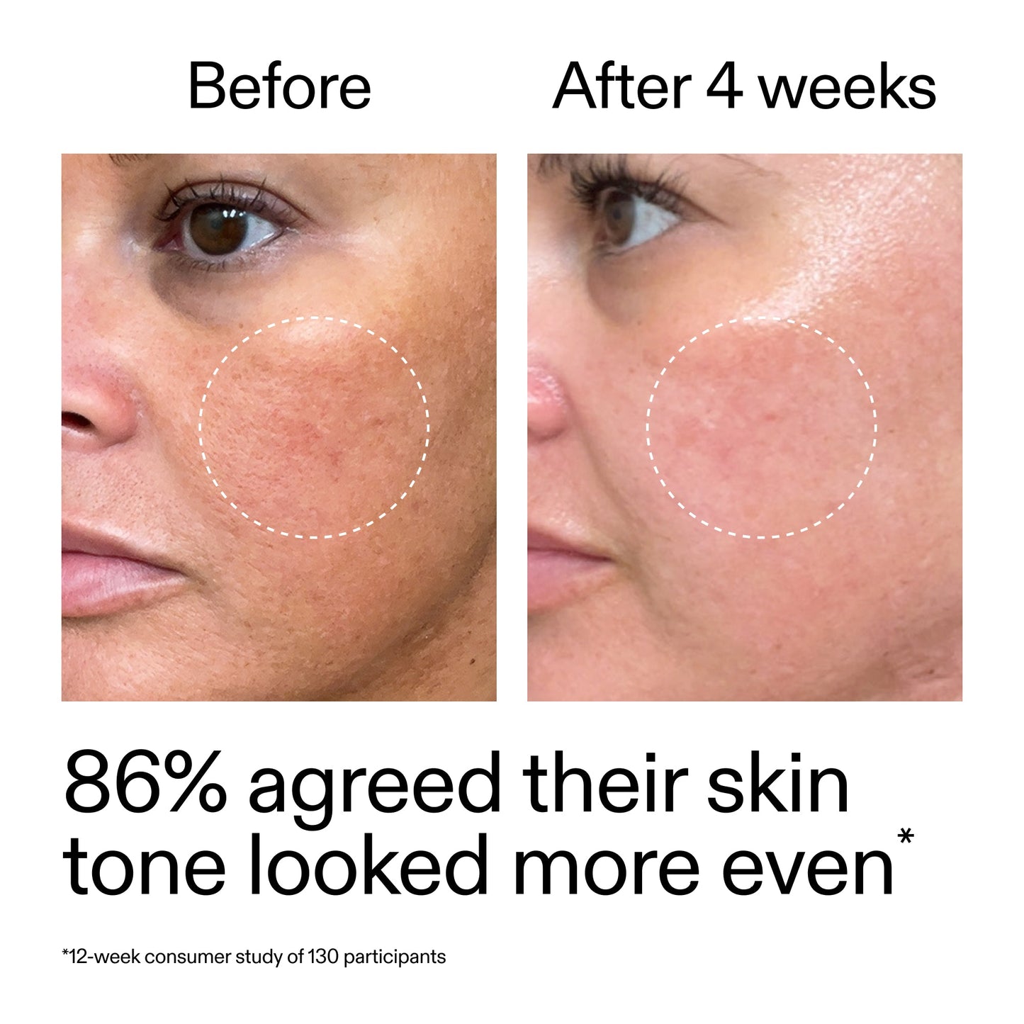 starter-retinol-serum-q6 StarterRetinol_BeforeAfter_Claim2_2000x2000_f5c9ecc0-8d76-429d-bef5-c3a61bcf5c09.jpg