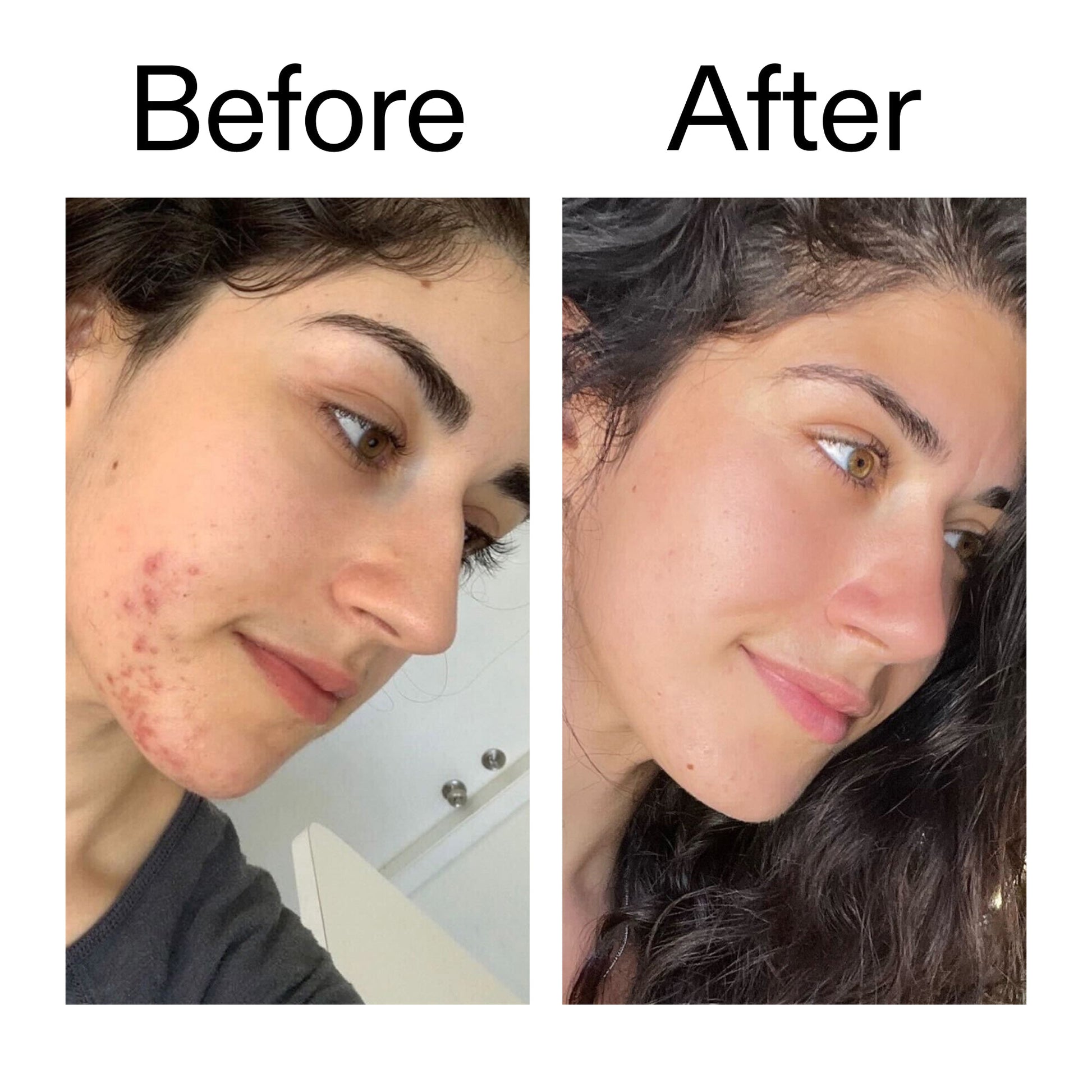 succinic-acid-acne-treatment-r0 Succinic_Acid_Treatment_Before_After_2000x2000_6a5f0054-2f58-4433-9314-0dc72c9bdd3b.jpg