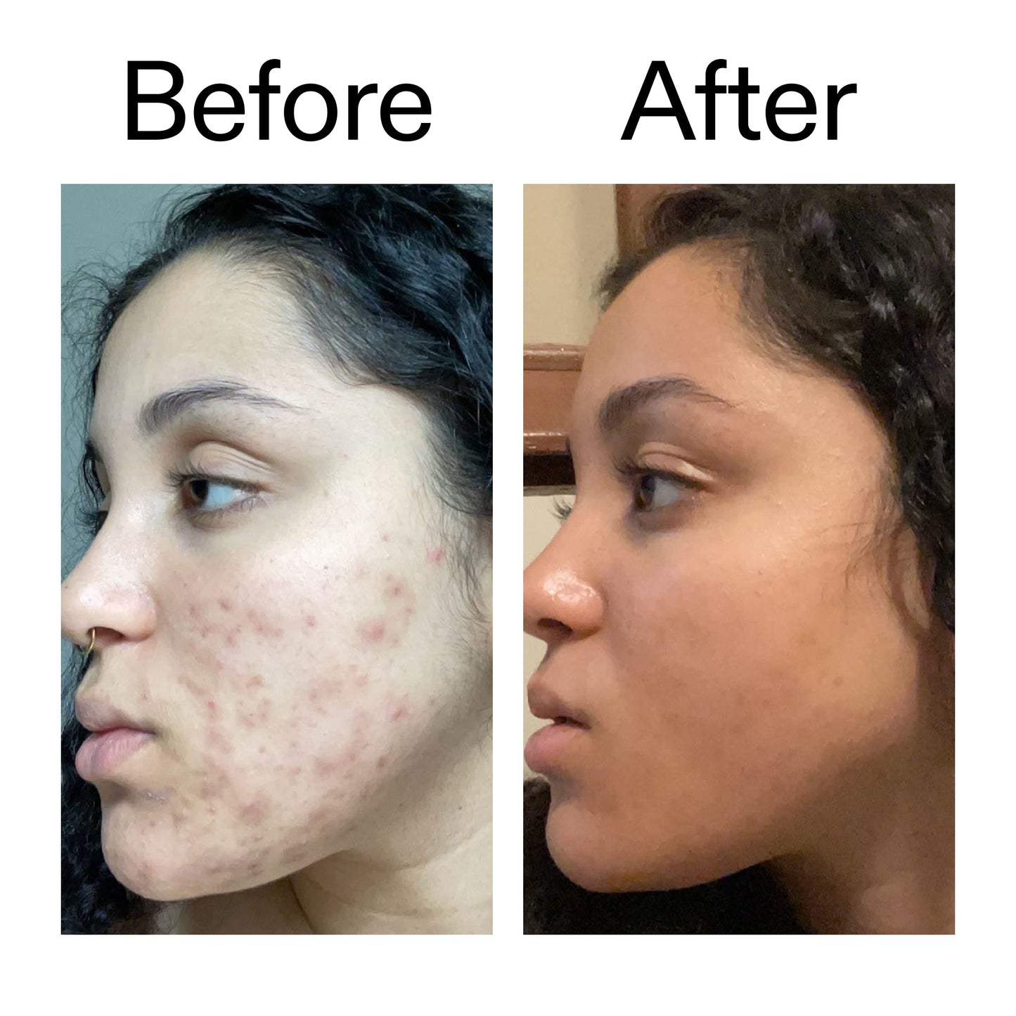 tranexamic-acid-serum-d2 Tranexamic_Acid_Serum_Before_After_2000x2000_98ebc8be-77b0-4843-8a22-90790ebe918b.jpg